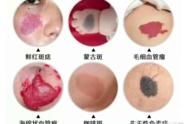 红胎记算命图解 红胎记算命图解