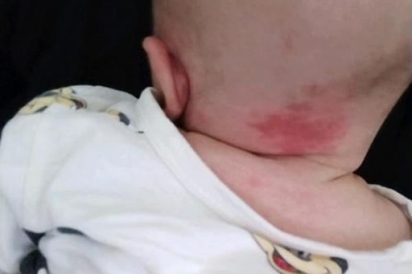 红胎记算命图解 红胎记算命图解