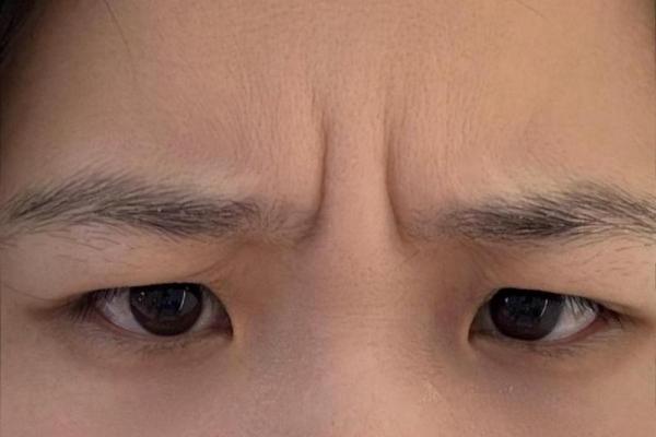 眉心八字纹 眉心八字纹