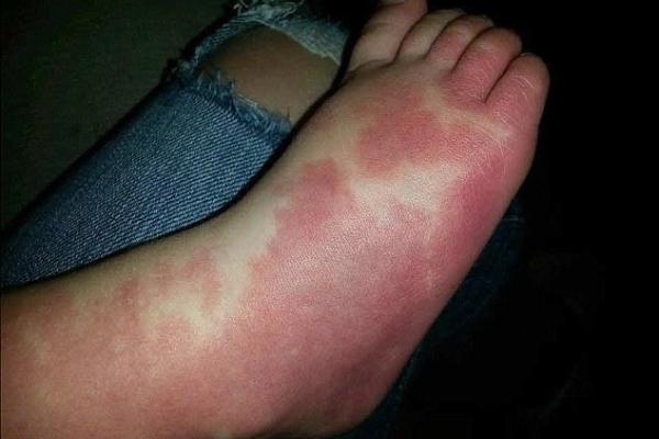 人体胎记算命的解释分析 人体胎记算命的解释分析