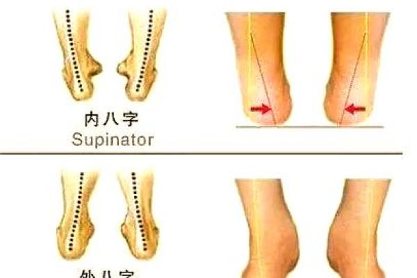 八字脚是什么 八字脚是什么