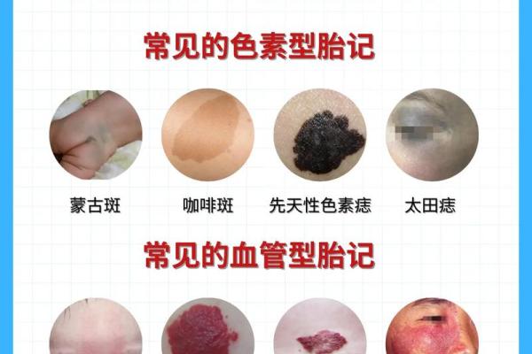 胎记算命的位置与命运 胎记算命的位置与命运