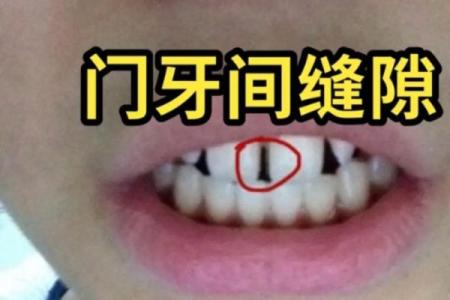 八字型门牙