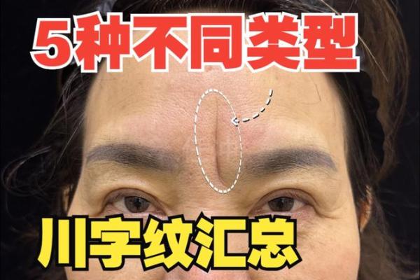 眉心凸起八字纹分析及治疗方法,了解眉心凸起八字纹原因 眉心凸起八字纹分析及治疗方法,了解眉心凸起八字纹原因