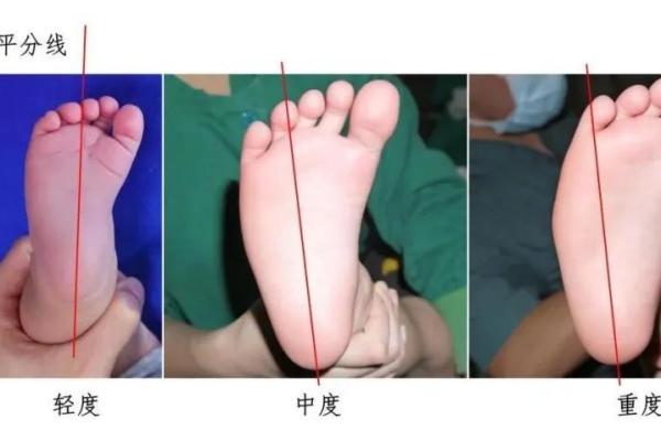 内八字、外八字孩子脚型正常不正常，家长可以这么判断