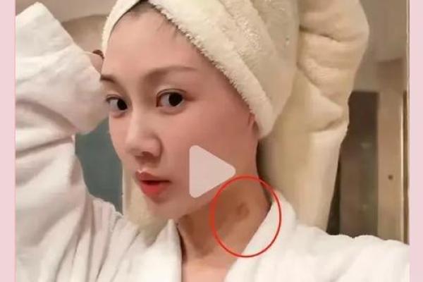 脖子上的胎记算命