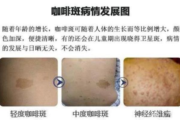 手指内侧长红胎记算命准吗