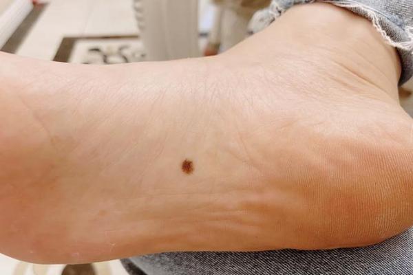 脚底的胎记算命分析