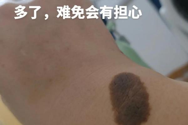 胎记算命：从胎记看运势