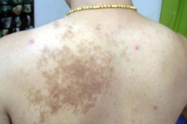 据脖子上胎记算命，有什么说法