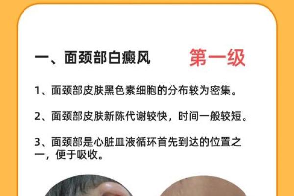白色胎记算命分析 白色胎记算命分析